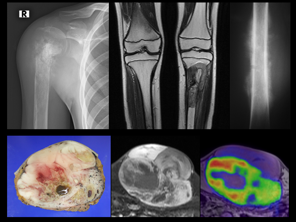 未分化多形肉腫